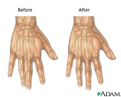 Before and after webbed finger repair