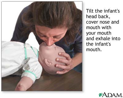 CPR on an infant under 1 year