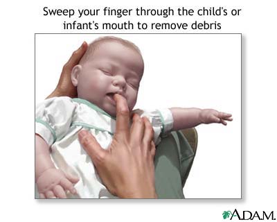 Heimlich maneuver on infant