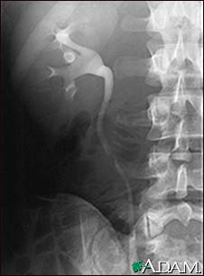 Adrenal tumor, intravenous pyelogram (IVP)