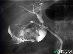 Cholecystitis, cholangiogram