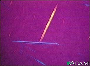 Uric acid crystals