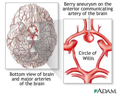 Cerebral aneurysm