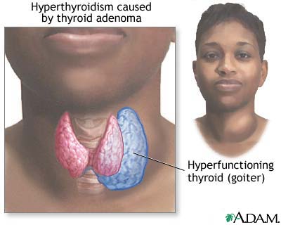 Hyperthyroidism