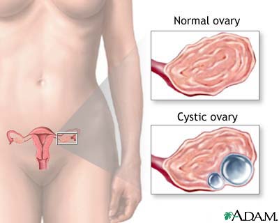 Ovarian cysts