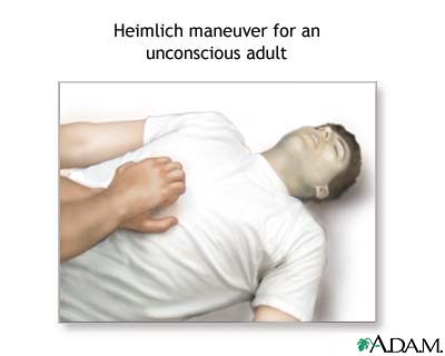 Unconscious Heimlich