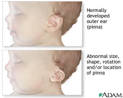 Ear abnormalities