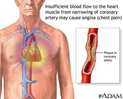 Stable angina