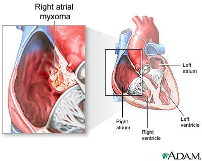 Right atrial myxoma