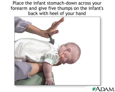 Heimlich maneuver on infant