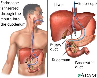 ERCP