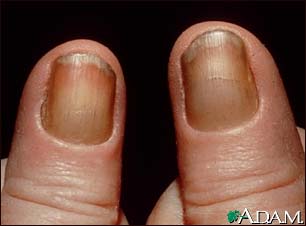 Yellow nail syndrome