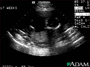 Ultrasound, normal fetus - ventricles of brain