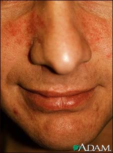 Rosacea