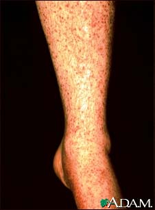 Vasculitis