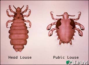 Head louse and pubic louse