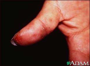 Dermatitis, herpetiformis on the thumb