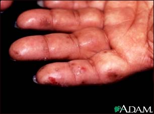 Dermatitis, herpetiformis on the hand