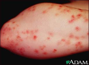 Dermatitis, herpetiformis on the forearm