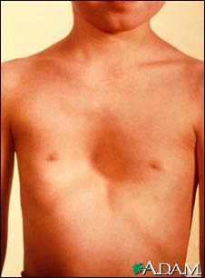 Pectus excavatum