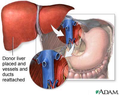 Donor liver attachment