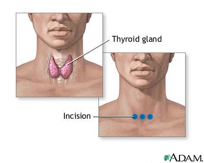 Incision for thyroid gland surgery