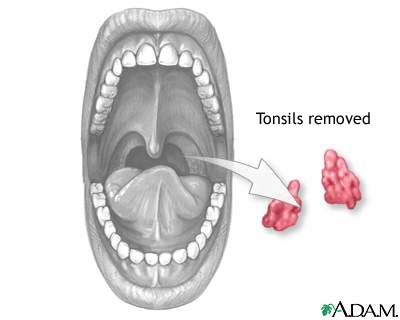 Tonsillectomy