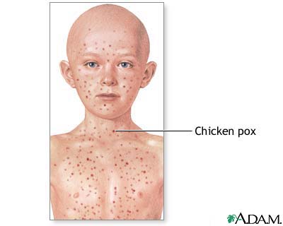 Chicken Pox