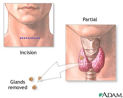 Parathyroidectomy