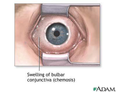 Chemosis