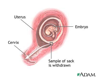 Chorionic villus sampling