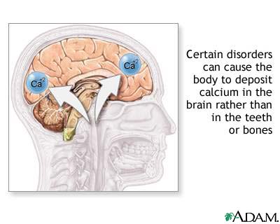 Cranial calcification