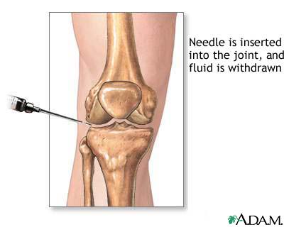 Joint aspiration