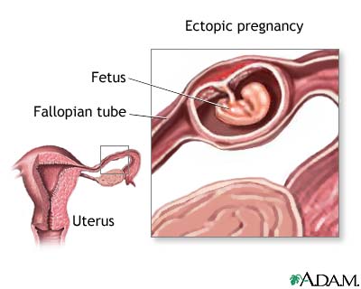 Ectopic pregnancy