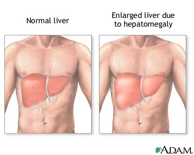 Hepatomegaly