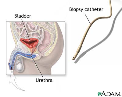 Bladder biopsy