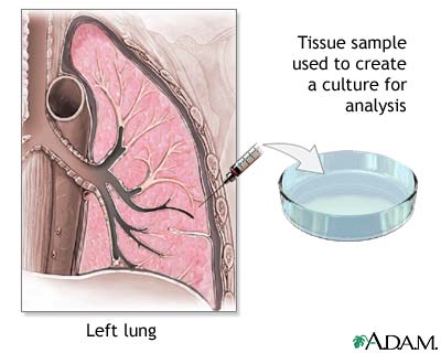 Lung tissue biopsy