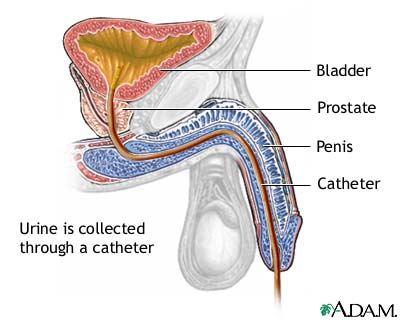 Catheterization