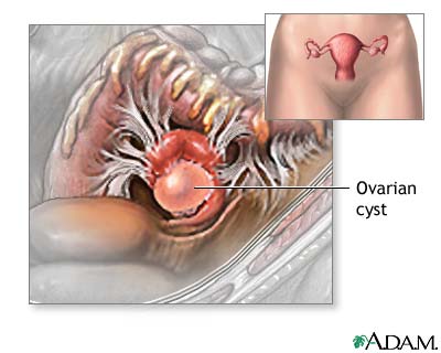 Ovarian cyst