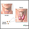 Parathyroidectomy